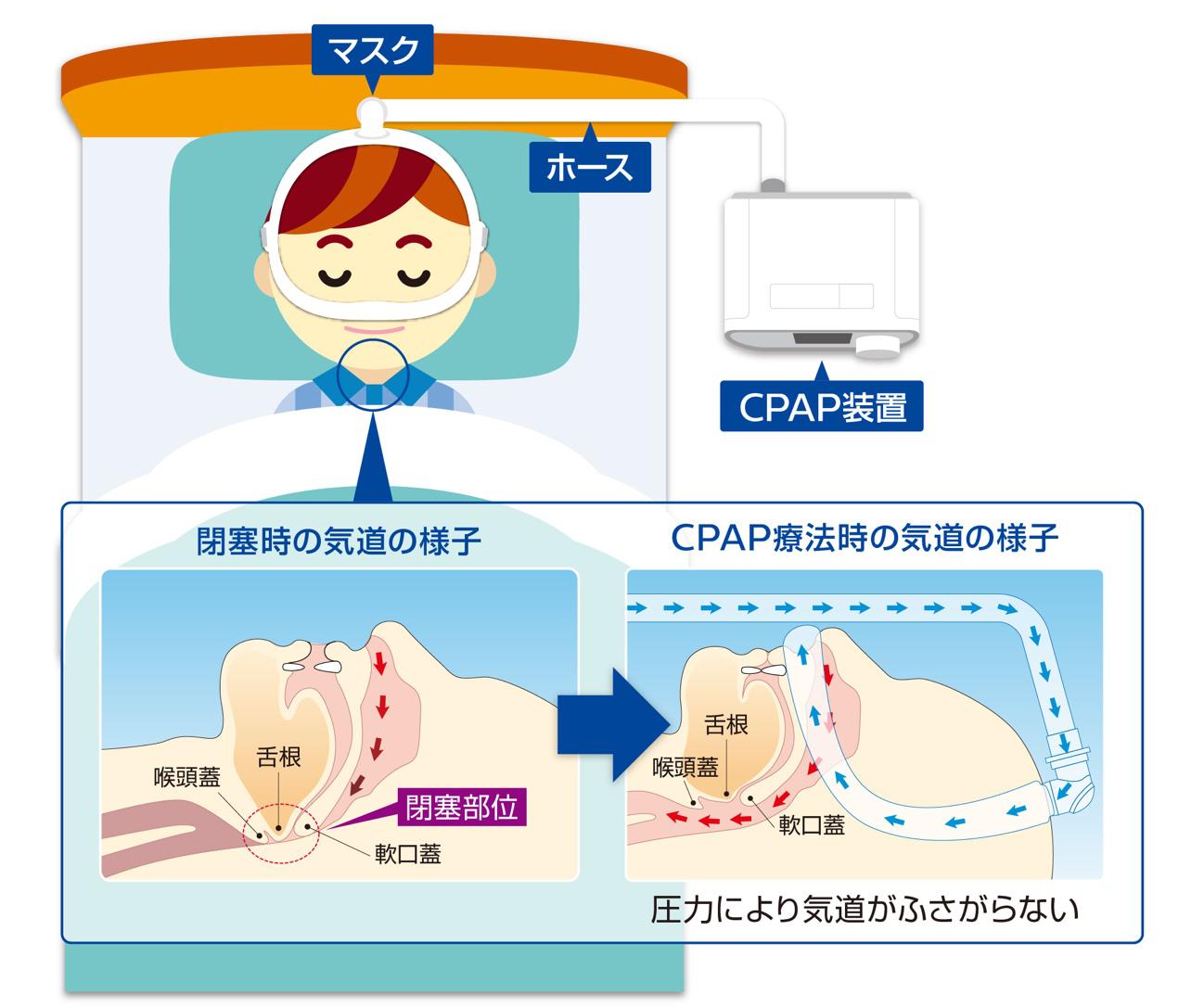 CPAP装置